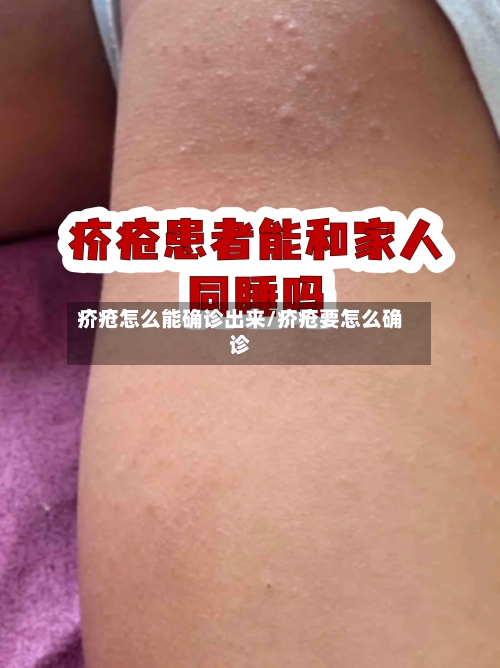 疥疮怎么能确诊出来/疥疮要怎么确诊
