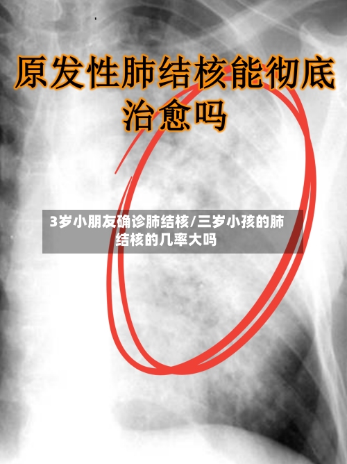 3岁小朋友确诊肺结核/三岁小孩的肺结核的几率大吗-第2张图片