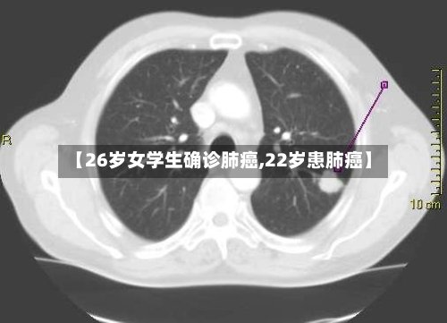 【26岁女学生确诊肺癌,22岁患肺癌】