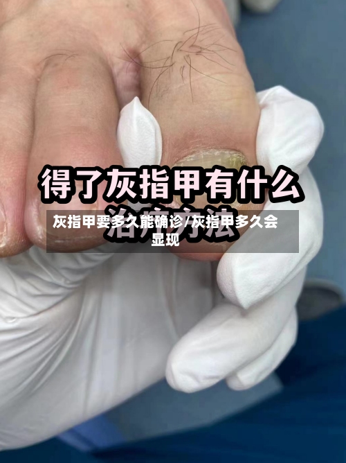 灰指甲要多久能确诊/灰指甲多久会显现