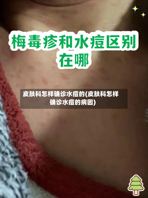 皮肤科怎样确诊水痘的(皮肤科怎样确诊水痘的病因)-第3张图片