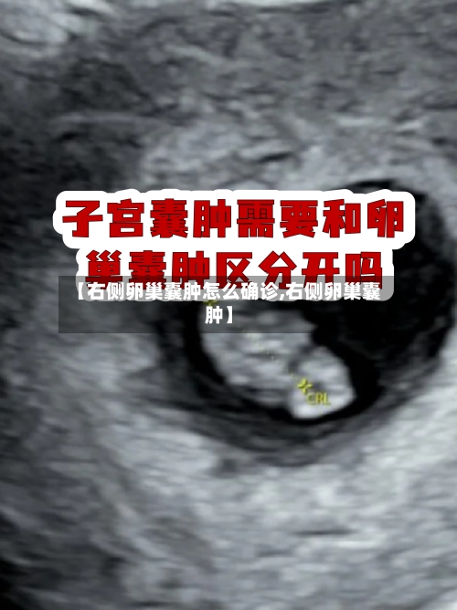 【右侧卵巢囊肿怎么确诊,右侧卵巢囊肿】-第3张图片