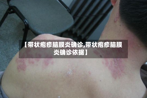 【带状疱疹脑膜炎确诊,带状疱疹脑膜炎确诊依据】-第2张图片