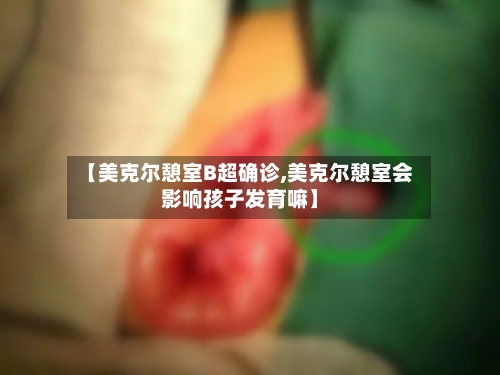 【美克尔憩室B超确诊,美克尔憩室会影响孩子发育嘛】