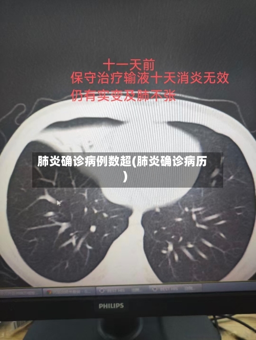 肺炎确诊病例数超(肺炎确诊病历)