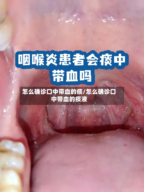 怎么确诊口中带血的痰/怎么确诊口中带血的痰液