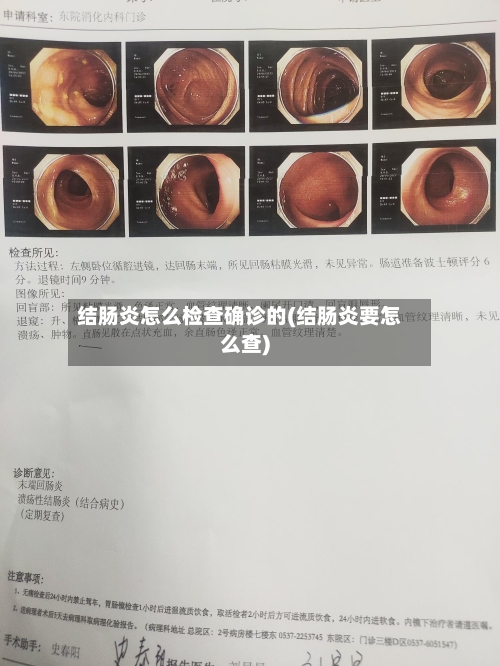 结肠炎怎么检查确诊的(结肠炎要怎么查)-第2张图片