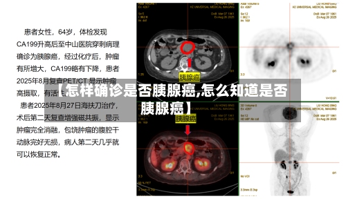 【怎样确诊是否胰腺癌,怎么知道是否胰腺癌】-第3张图片