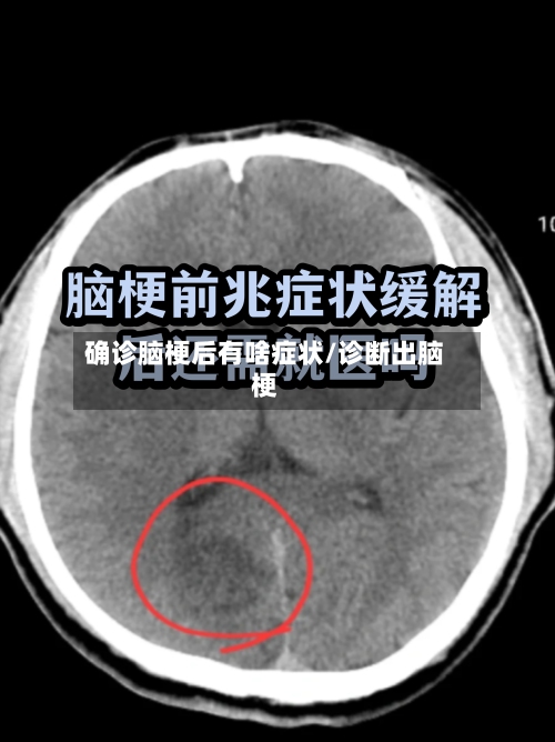 确诊脑梗后有啥症状/诊断出脑梗-第2张图片